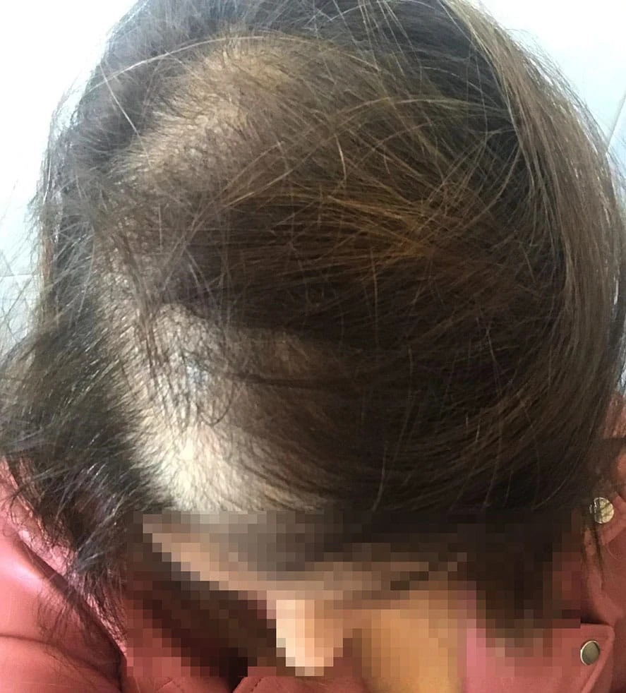 "অল্প বয়সে চুল পড়ার কারণ ও প্রতিকার: জানুন কীভাবে আগেই সচেতন হবেন"